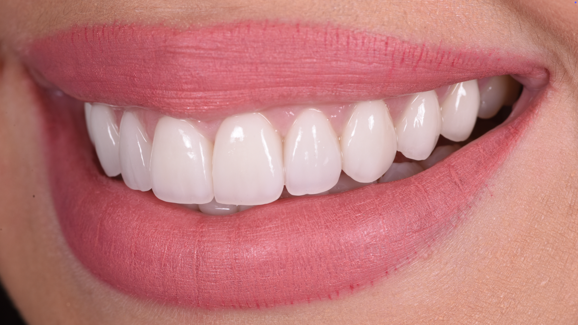 Natural Smile Makeover