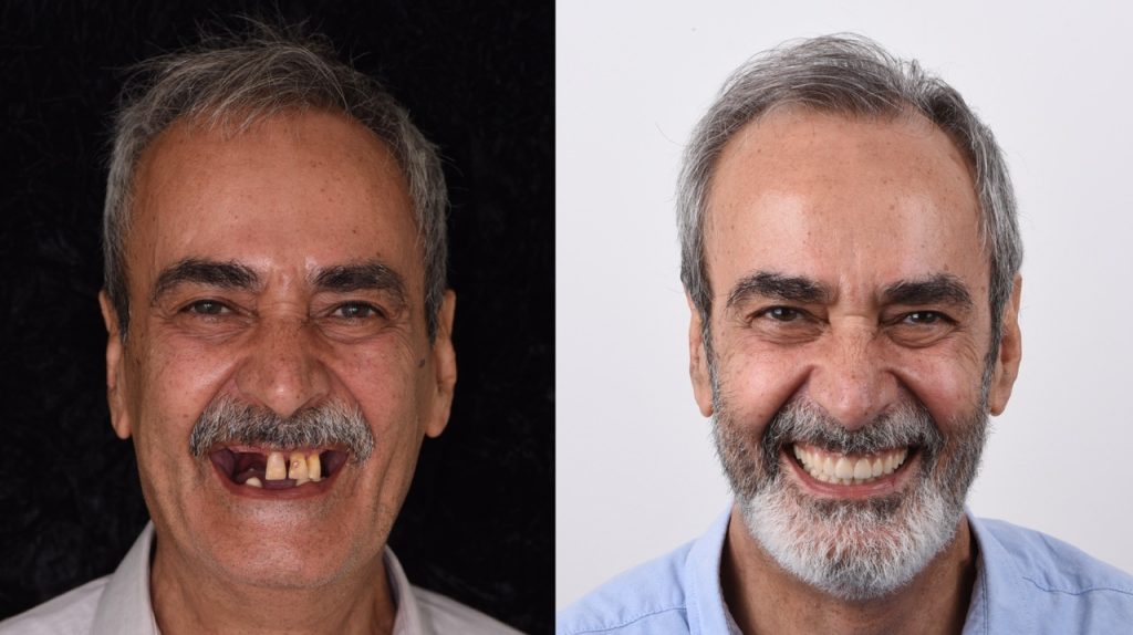 Full mouth rehabilitation with dental implants