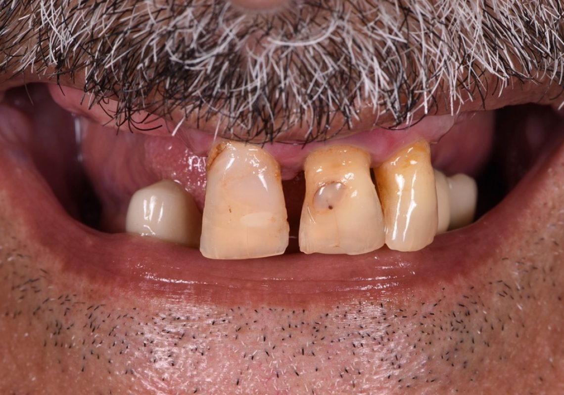 Full mouth rehabilitation with dental implants - Before