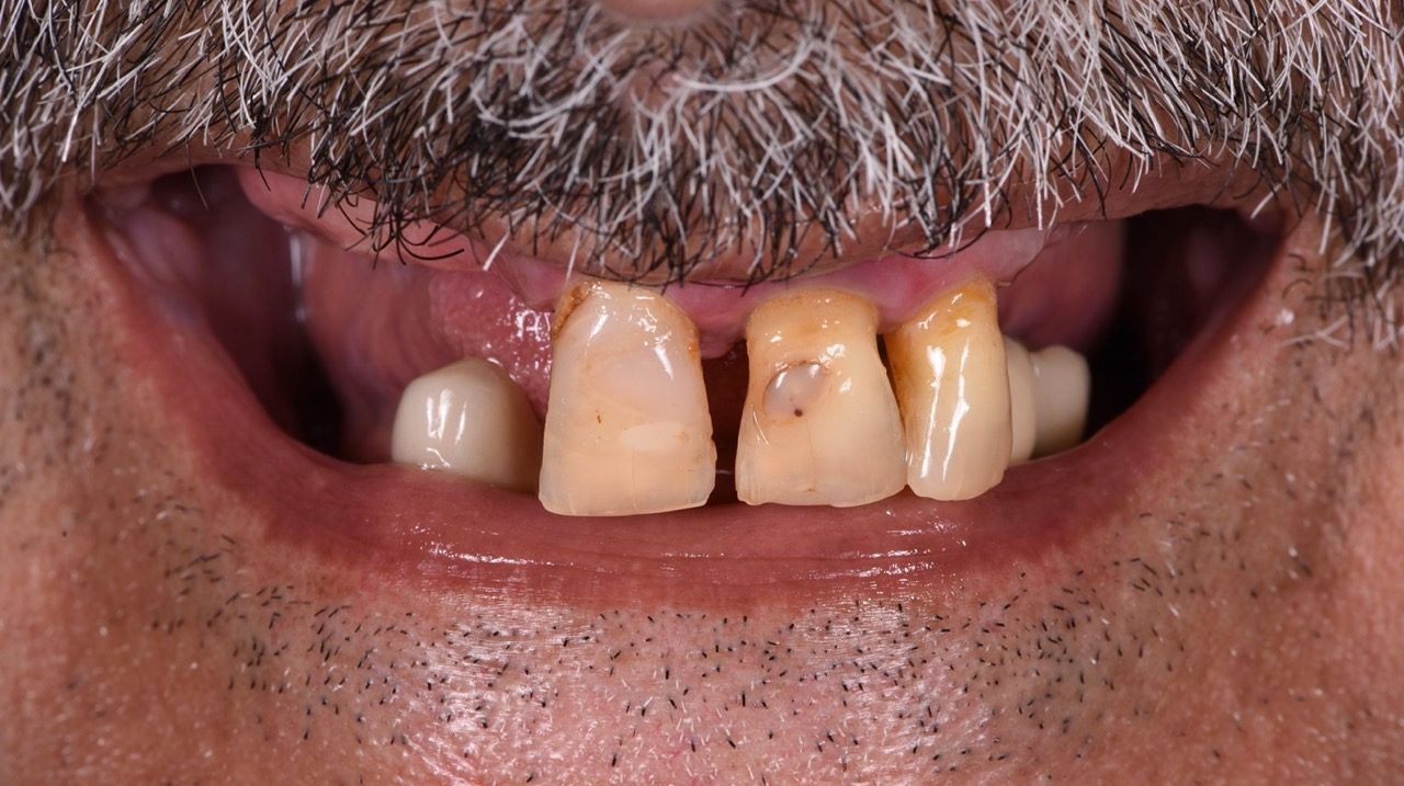 Full mouth rehabilitation with dental implants - Before