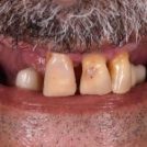 Restoring Smiles with Dental Implants: Ahmed’s Transformation