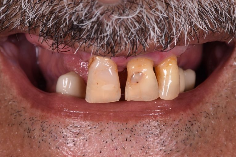 Full mouth rehabilitation with dental implants - Before