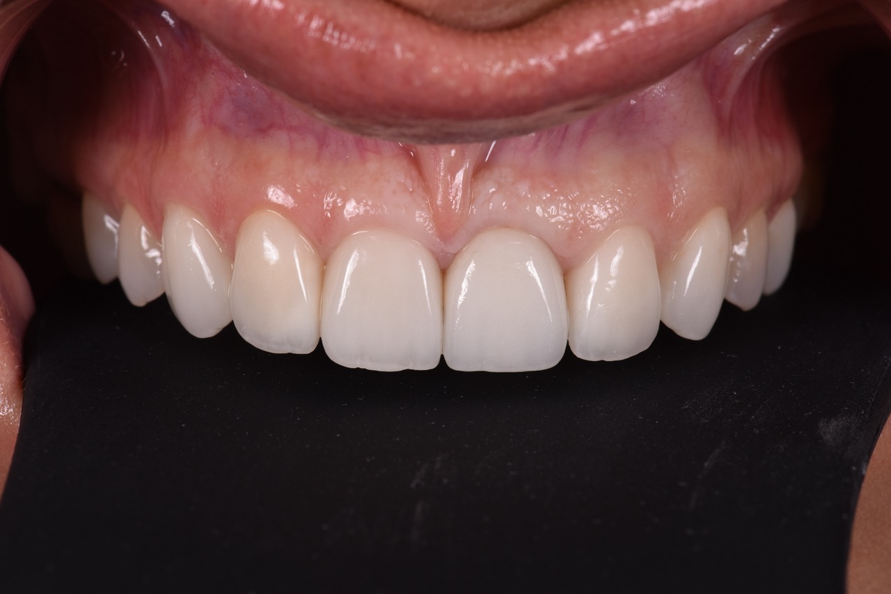 DSC_7807_dental_implant_restoration
