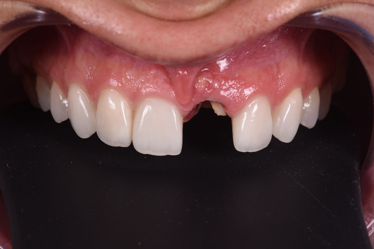 before_dental_implant_restoration