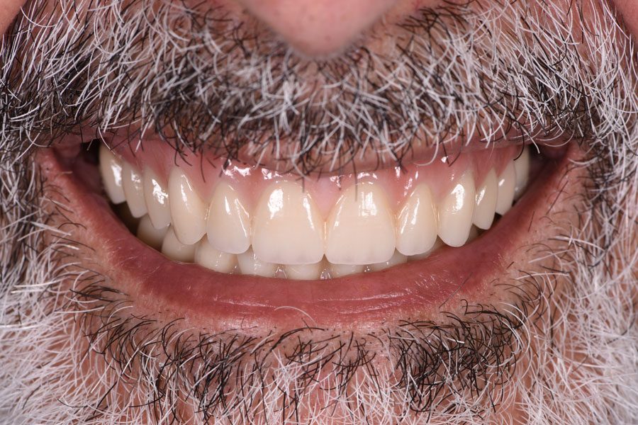 Full-Mouth Implant Rehabilitation - Dr David Montalvo - After