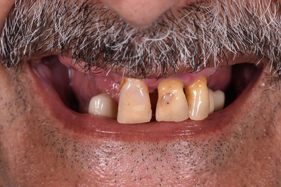 Full-Mouth Implant Rehabilitation - Dr David Montalvo - Before