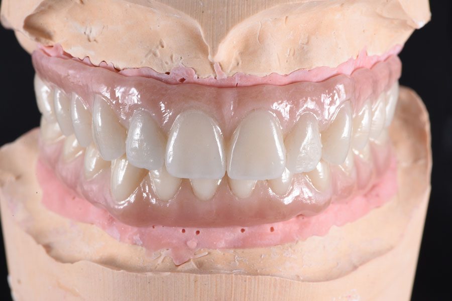 Full-Mouth Implant Rehabilitation - Dr David Montalvo - Process