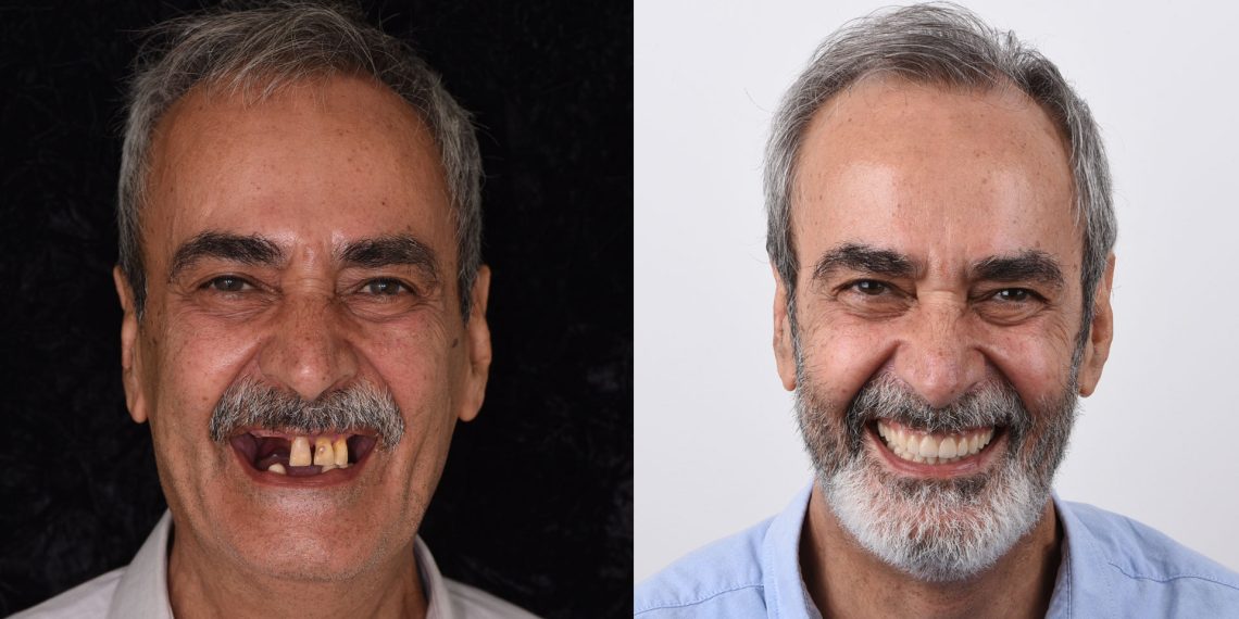 Full-Mouth Implant Rehabilitation - Dr David Montalvo