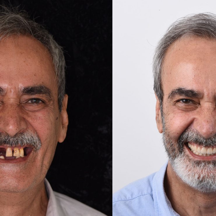 Full-Mouth Implant Rehabilitation - Dr David Montalvo