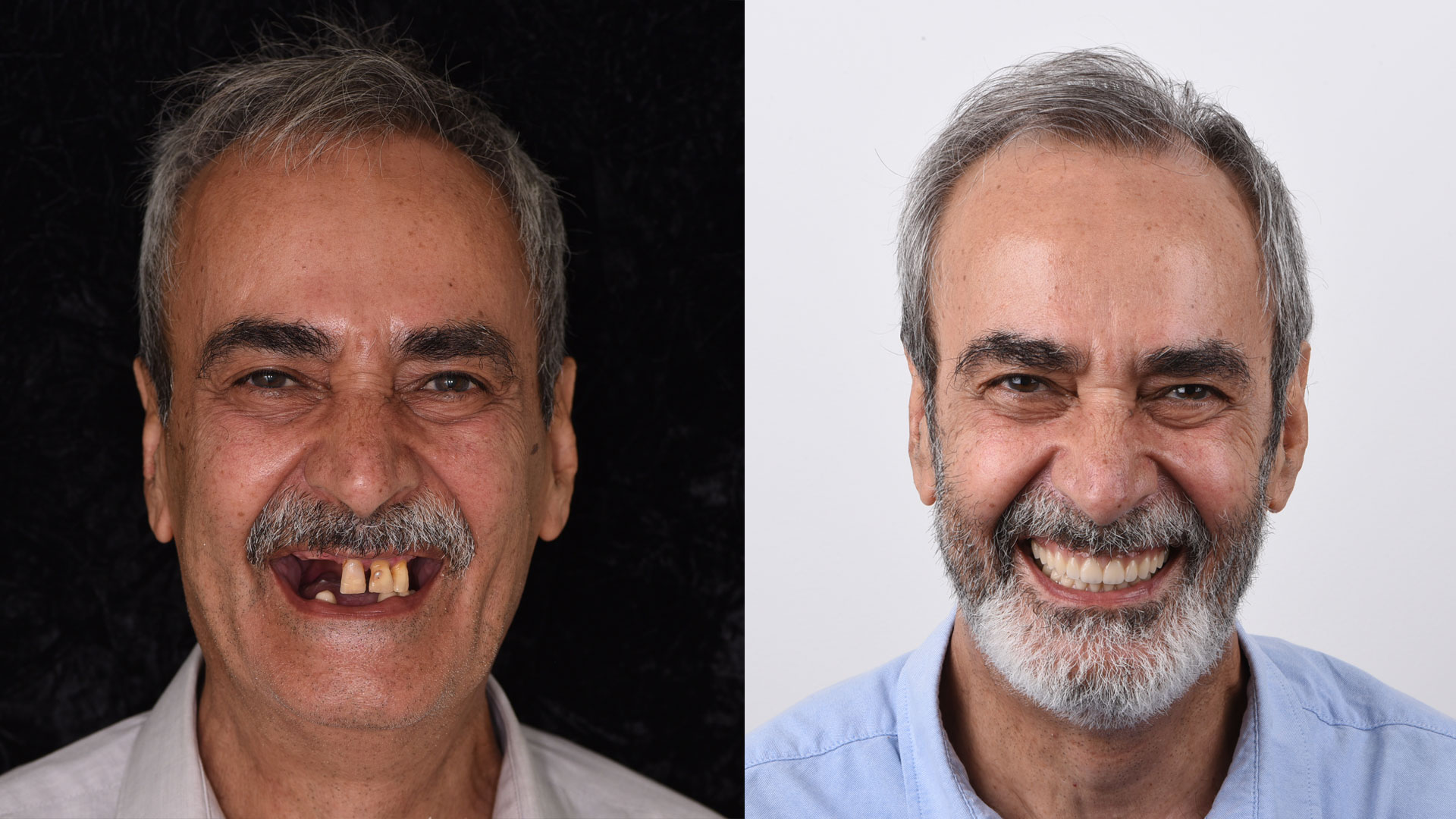 Full-Mouth Implant Rehabilitation - Dr David Montalvo