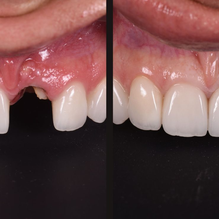 Single implant restoration after trauma