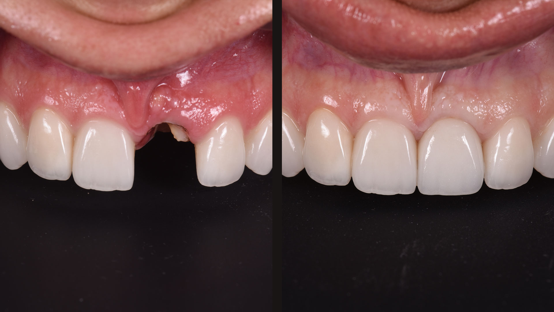 Single implant restoration after trauma
