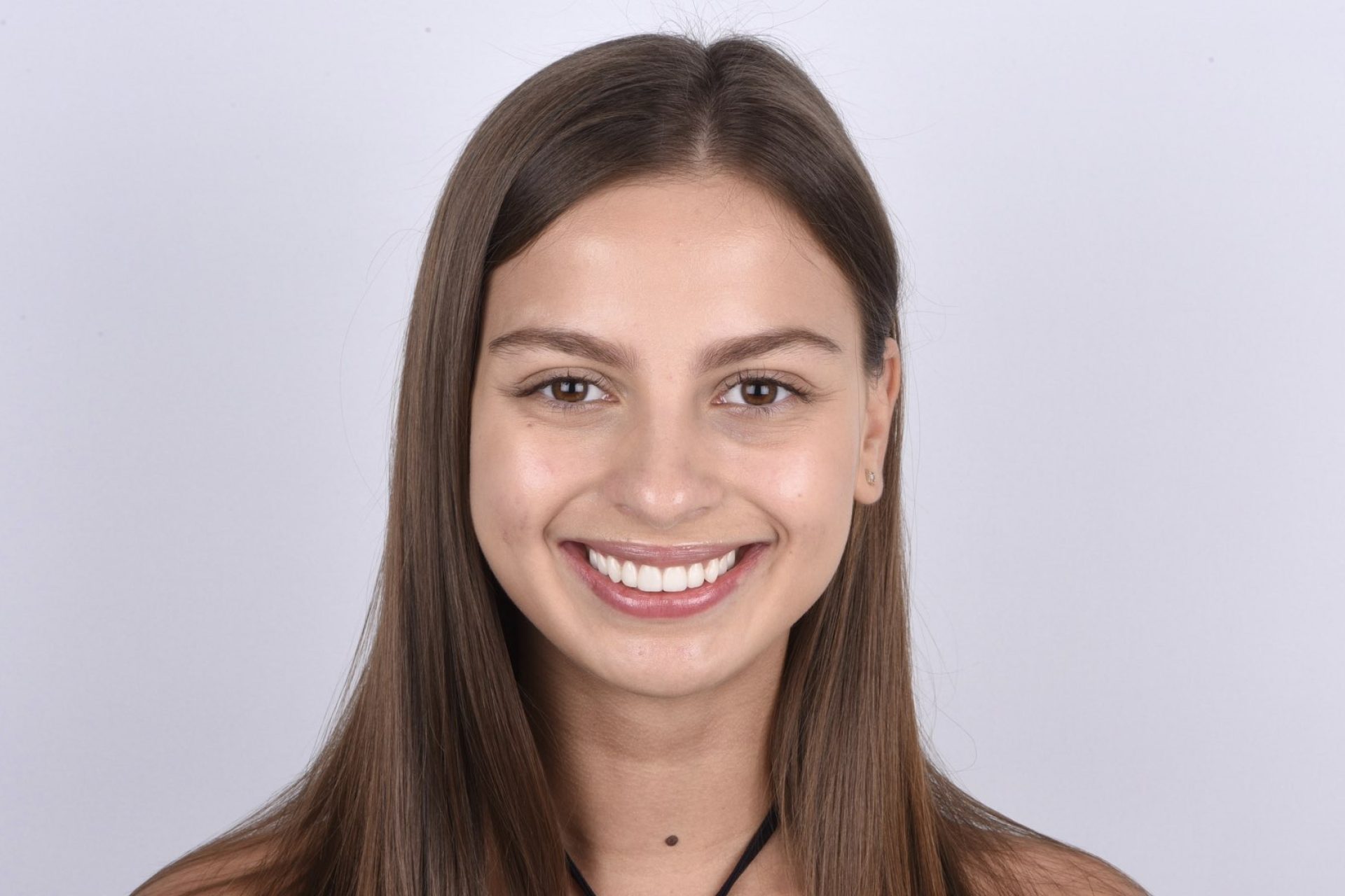 Smile Design - Before and after Kate 004