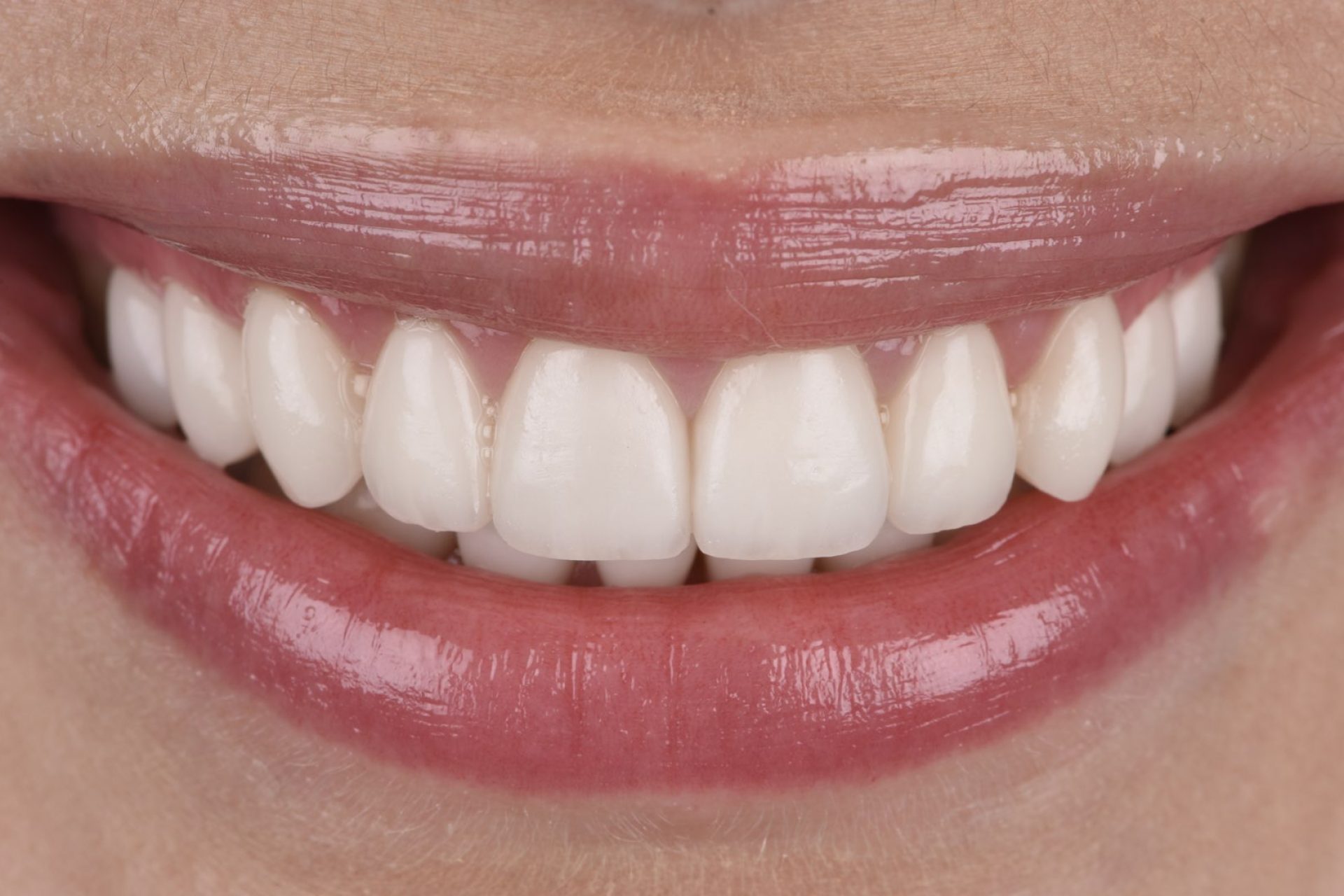 Smile Design - Before and after Kate 005