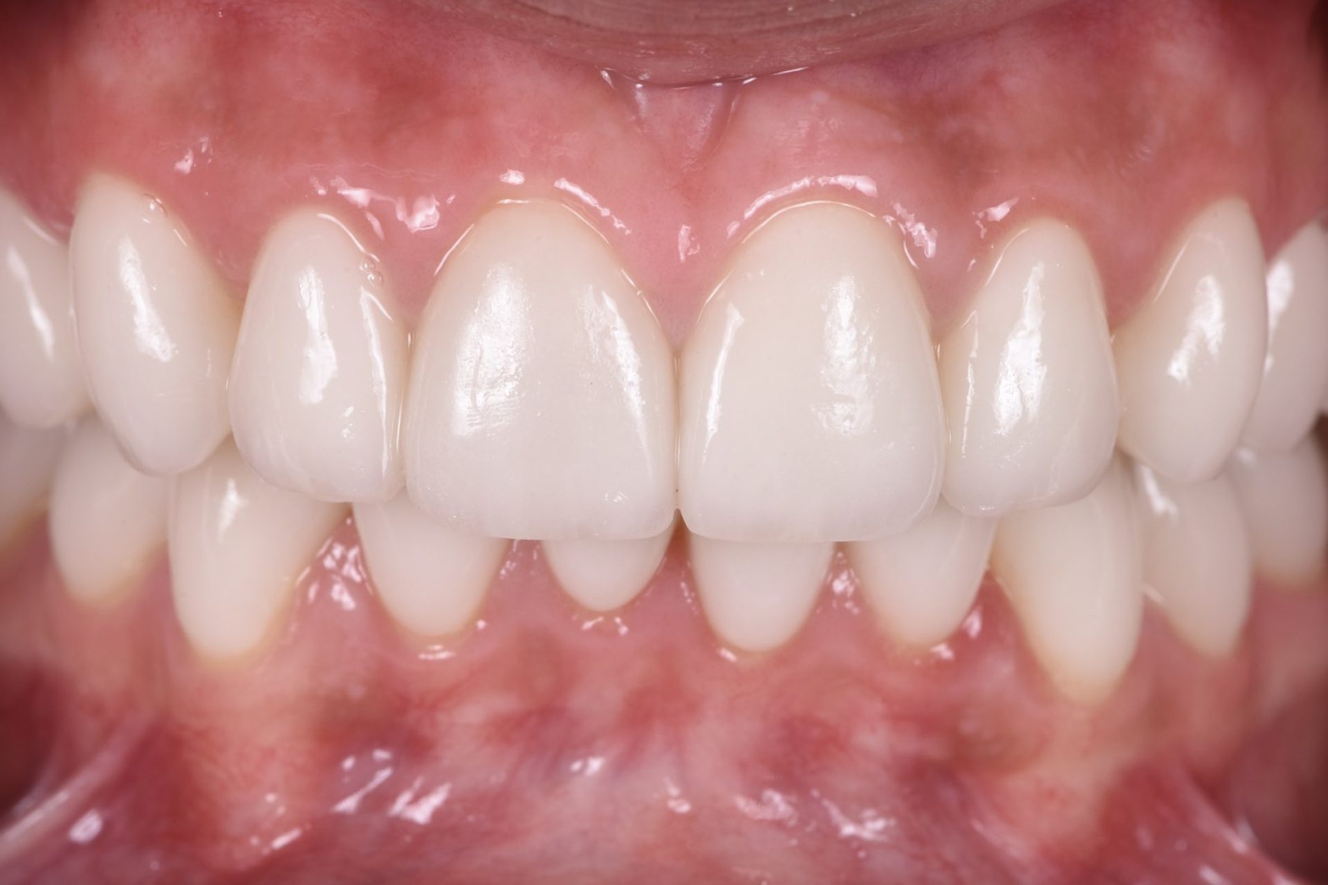 Smile Design - Before and after Kate 006