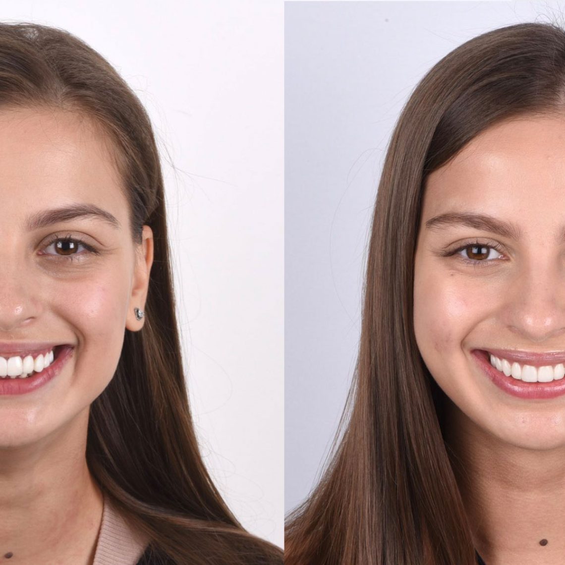 Kate’s Case When a smile looks good… but doesn’t feel right