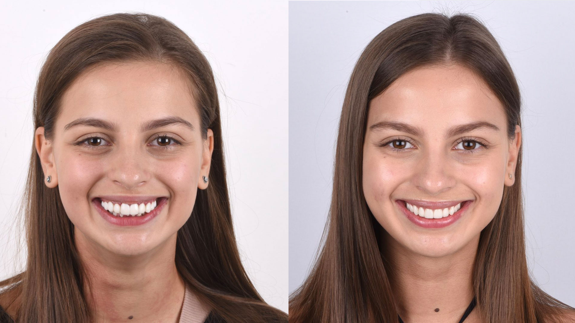 Kate’s Case When a smile looks good… but doesn’t feel right