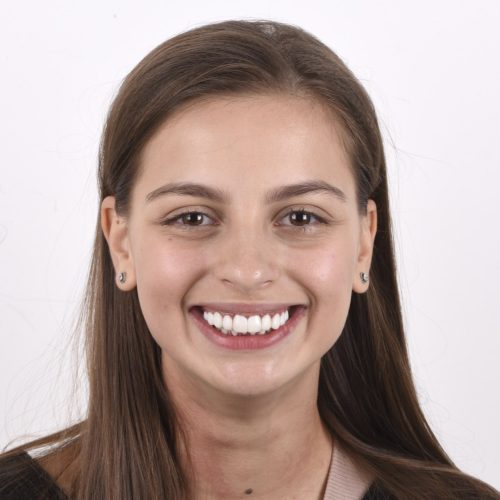 Smile Design - Before and after Kate 001