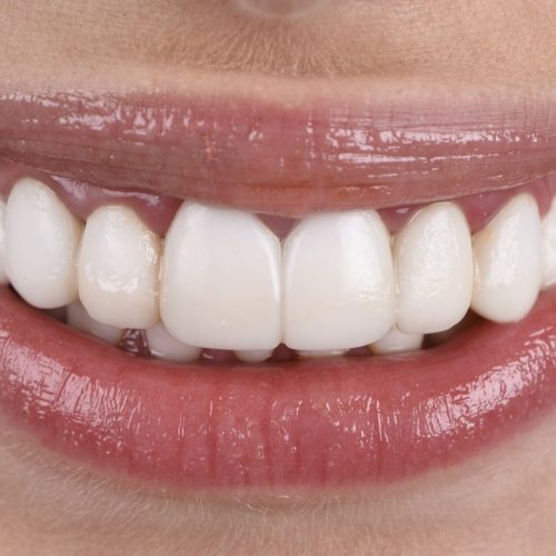 Smile Design - Before and after Kate 002