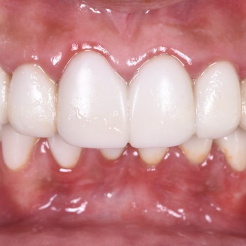 Smile Design - Before and after Kate 003