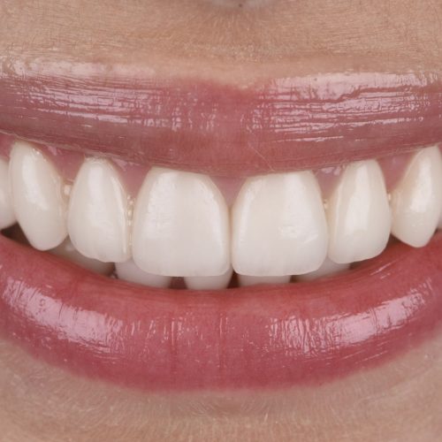 Smile Design - Before and after Kate 005