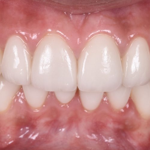 Smile Design - Before and after Kate 006