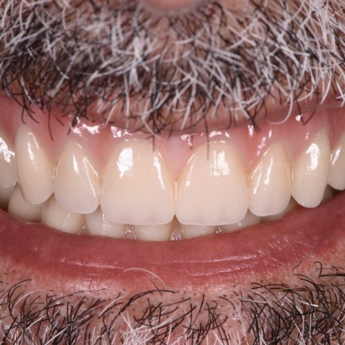 Full mouth rehabilitation with dental implants - Final