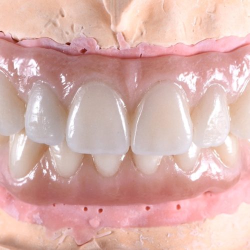 Full mouth rehabilitation with dental implants - Process