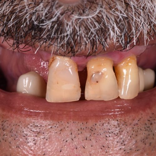 Full mouth rehabilitation with dental implants - Before